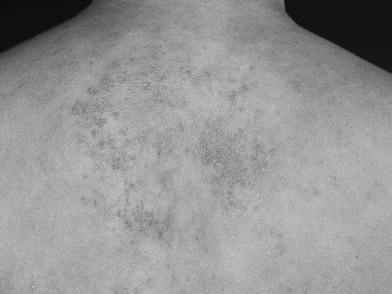 Texture red rash on back man